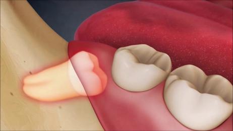 Xử trí thế nào khi răng khôn 'mọc dại'
