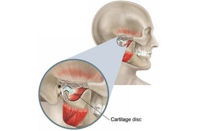 Viêm khớp thái dương hàm là bệnh gì?