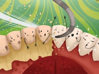 PROCARE XIN CHIA SẺ VỚI BẠN- NHỮNG ẢNH HƯỞNG CỦA CAO RĂNG ĐẾN SỨC KHỎE