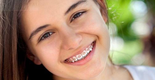 Phương Pháp Vệ Sinh Răng Miệng Sau Khi Niềng Răng
