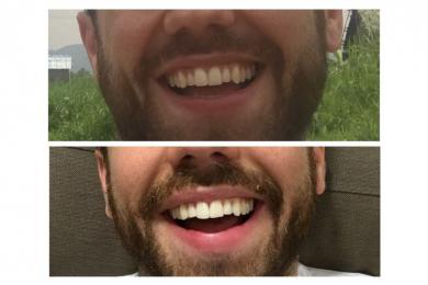 Review chỉnh nha Invisalign (máng năng trong suốt): Sở hữu nụ cười rạng rỡ mà không cần đeo mắc cài kim loại