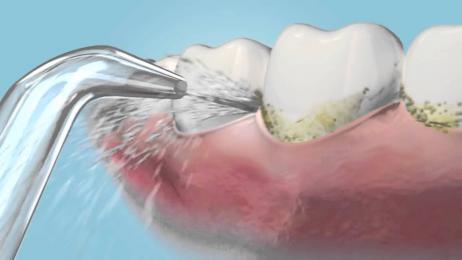 Những lợi ích của máy tăm nước trong việc chăm sóc răng miệng