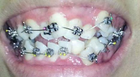 NHỮNG TRƯỜNG HỢP CẦN NHỔ RĂNG KHI NIỀNG ?