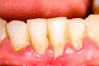 VÔI RĂNG LÀ GÌ? CÓ NÊN CẠO VÔI RĂNG HAY KHÔNG? CẠO VÔI RĂNG NHIỀU CÓ TỐT HAY KHÔNG?