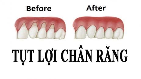 Tụt lợi. Nguyên nhân là do đâu ???