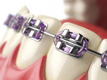 GIẢI ĐÁP NHỮNG BĂN KHOĂN VỀ NIỀNG RĂNG