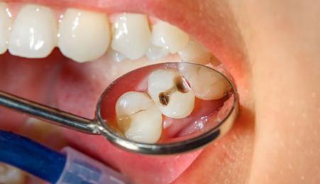 CẢNH BÁO VỀ SÂU RĂNG