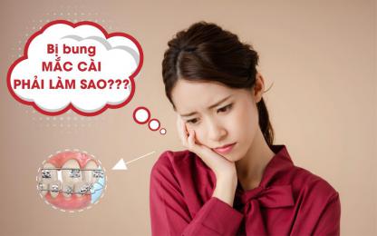 Bị bung mắc cài khi niềng răng phải làm sao?