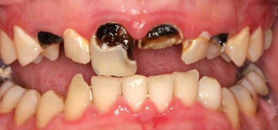 RĂNG LẤY TỦY CÓ NÊN BỌC RĂNG SỨ LẠI KHÔNG?