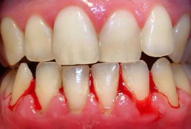 BÍ QUYẾT KHÔNG BỊ CHẢY MÁU CHÂN RĂNG